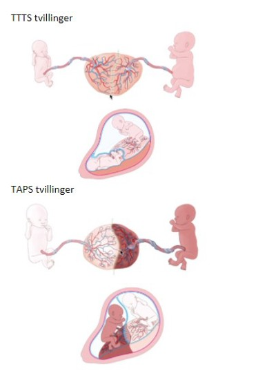 Image for TTTS og TAPS - Hva er det?